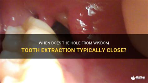 When Does The Hole From Wisdom Tooth Extraction Typically Close Medshun