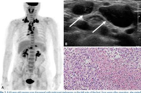 Figure From Extensive Tuberculous Lymphadenitis Mimicking Distant