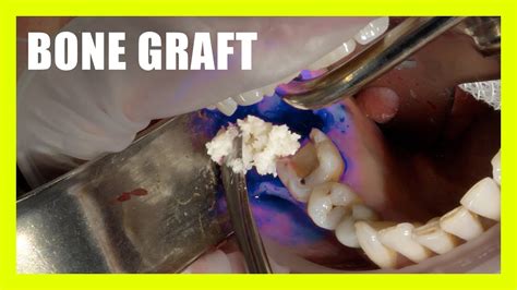 Socket Preservation Bone Graft Surgery YouTube