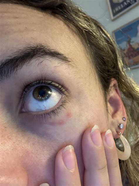 Red Spots Under Eyes Rdermatologyquestions