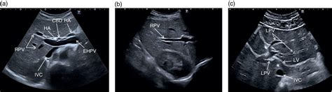 Normal Liver Anatomy Radiology Key