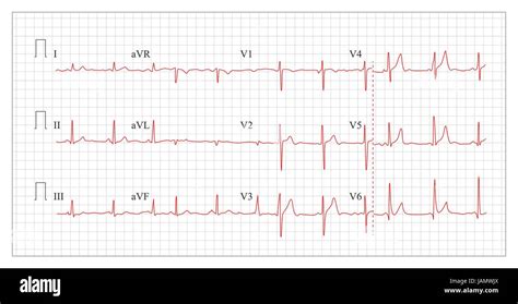 Heart Cardiogram Chart Vector Set Healthy Heart Rhythm Ischemia