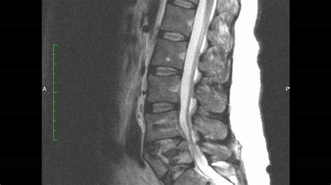 Lumbar Pedicle Fracture Treatment Therapy – FRACTURE