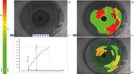 Ms Vorderabschnitts Oct Cornea Topographiesystem Bon Optic