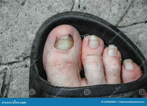 Toenails Affected By An Infectious Disease Fungal Infection Of The Nail