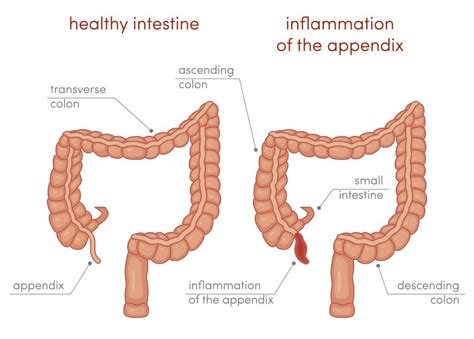 Acute Appendicitis Pathophysiology Managment Teachmepaediatrics