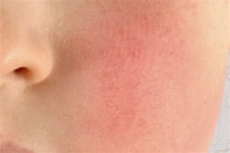 Rash 36 Common Skin Rashes Pictures Causes And Treatment