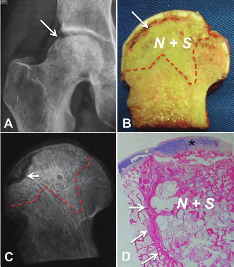 Caracterização da ON da cabeça femoral em um paciente do sexo masculino