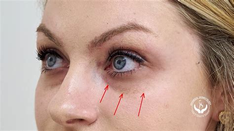 Belotero Injection For Under The Eyes Before And After Youtube