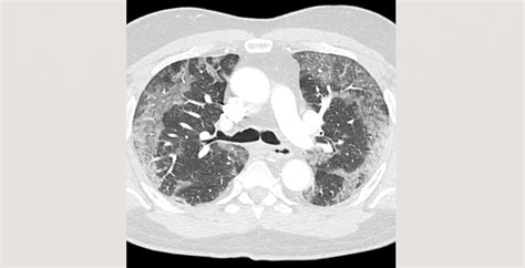 Elsevier Covid-19 Healthcare Hub | RADIOLOGY, from Chest Team COVID-19