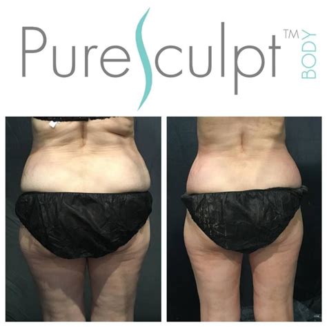 PureSculpt PureSculpt Beauty Body Treatments Body Contouring Beauty