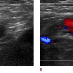 Pdf Ultrasonographic Diagnosis Of Round Ligament Varicosities