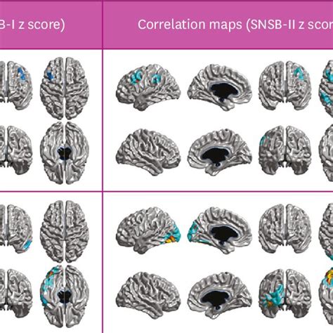 Difference In Cortical Atrophy Pattern Between Correlation Maps With