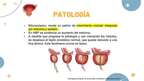 Hiperplasia prostática benigna y cáncer de próstata PPT