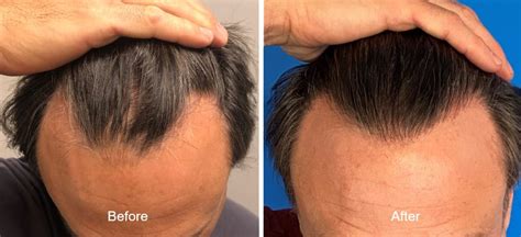 The 5 Best Countries For A Hair Transplant In 2023