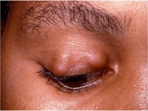 Eyelid Cyst Chalazion Eye Clinic