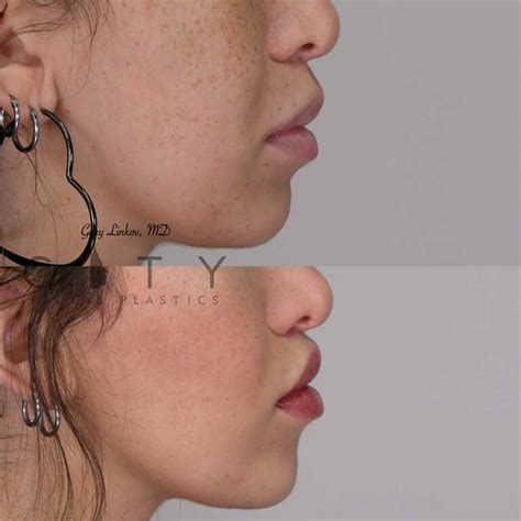 NYC Philtrum Contouring Lip Lift Dr Gary Linkov Plastischer