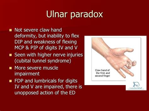 Ulnar Nerve Injury Claw Hand