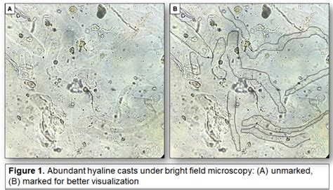 Urine Sediment Of The Month Colorless Transparent Hyaline Casts