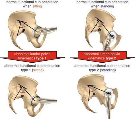 Fig 113 Classification Of Abnormal Lumbo Pelvic Sagittal Kinematics