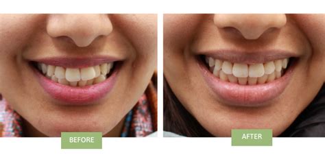 Invisalign Before And After Crooked Teeth