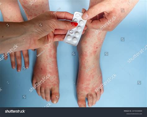 Foot Rash On Top Foot Photos, Images & Pictures | Shutterstock