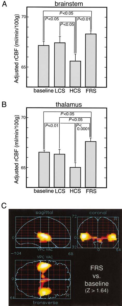 Averaged Regional Cerebral Blood Flow Rcbf At The Activated Foci In A