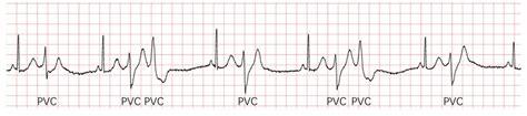 Premature Ventricular Contractions Ecg