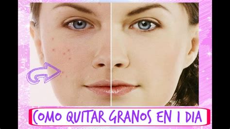 Como Quitar Granos Del Rostro En D A R Pido Y Eficaz Tipsbyaime