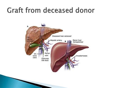 Ppt Liver Transplantation Powerpoint Presentation Free Download Id 4078441