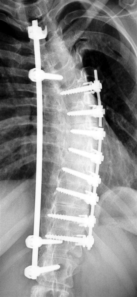 Failure of spinal fusion often requires salvage surgery. Failure of the ...