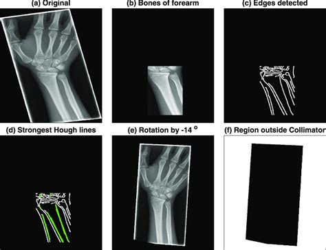 Graphical Illustration Of The Steps For Image Analysis Radiographs Are