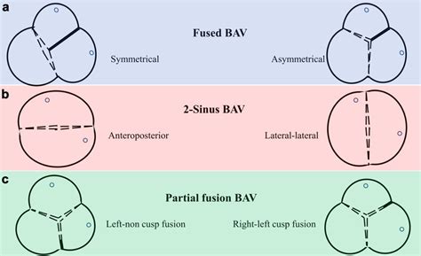 A New International Consensus Classification Of Bicuspid Aortic Valve