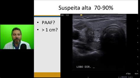 Ultrassonografia Da Gl Ndula Tireoide Youtube