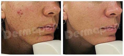 Microneedling Acne Scars Archives - Dermapen