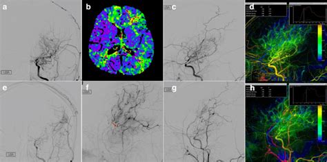 Preoperative Digital Subtraction Angiography Dsa Of The Left