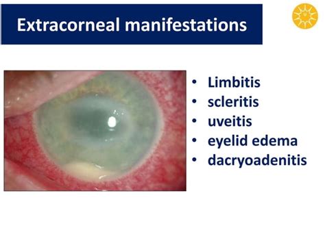 Acanthamoeba Keratitis Ppt