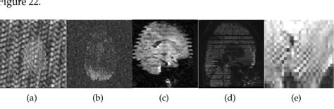 Examples Of Dwi Acquisition Artifacts A Electromagnetic