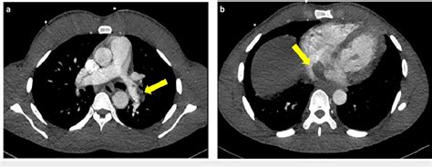 CT Angiogram CT: Computed Tomography; PE: Pulmonary Embolism a) CT... | Download Scientific Diagram