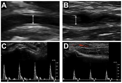 Distal Transradial Access Optimization A Prospective Trial Of Ultrasound Guided Radial Artery