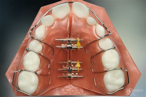 Demonstrates A Removable Appliance With Midline Screws To Widen The