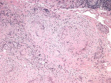 Sarcoidosis Affecting The Lacrimal Gland