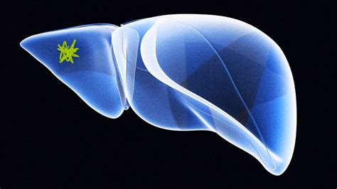 HCC liver cancer: Symptoms, causes, and treatment