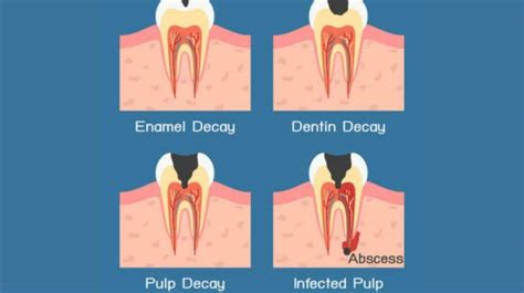 Can A Tooth Abscess Be Treated With Just Antibiotics