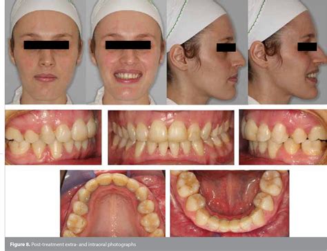 Figure 1 From Patient With Severe Skeletal Class Ii Malocclusion Double Jaw Surgery With