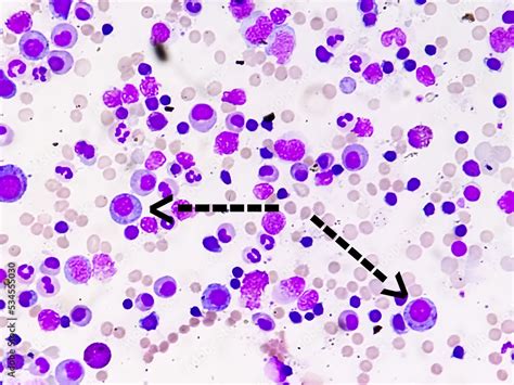 Plasma Cells In Bone Marrow