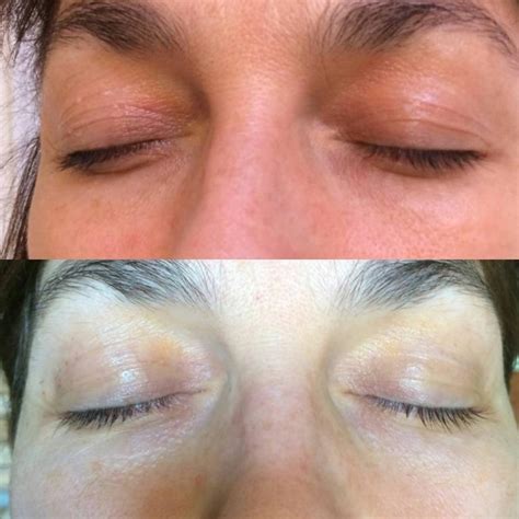 Non Surgical Eye Lift Sydney