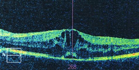 Automatic Detection of Macular Cysts | RSIP Vision