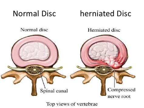 Intervertibral Disc Prolapse Docjoints Dr Sujit Jos Joint Surgeon