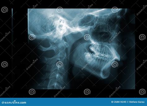 X Ray Of The Cervical Spine Film X Ray C Spine Lateral View